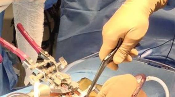 Spinal Tumor Treatment in Kolkata: Consult Top Spine Neurosurgeon in India