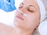 If You’re Considering Chemical Peel…